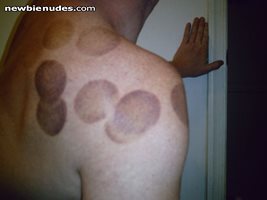 decided to try a new massage (cupping) this is 3 days later